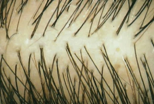 Représentation visuelle de la densité capillaire avant l'utilisation de Folicerin