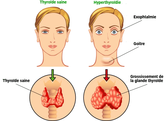 Illustration de la glande thyroïde soulignant son importance